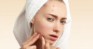 6 modi per curare l'infezione da acne