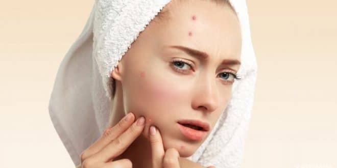 6 modi per curare l'infezione da acne