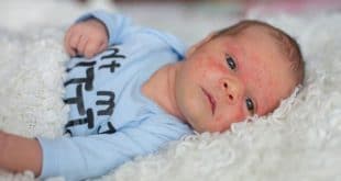 3 cause di sensibilità cutanea nei neonati