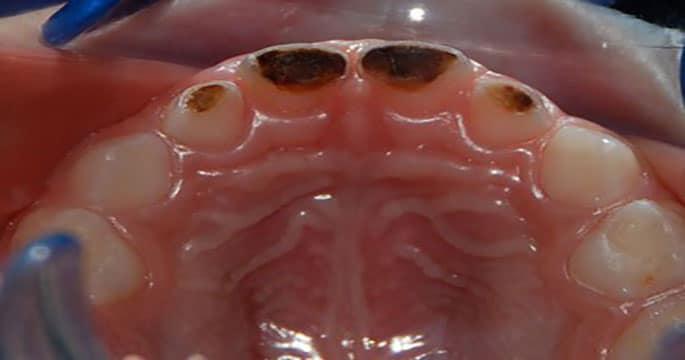 Carie dei denti anteriori - La carie dei denti anteriori dalla parte posteriore