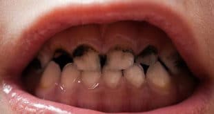 Come si verifica la carie dei denti anteriori?
