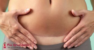 Qual è la forma della seconda ferita da parto cesareo?
